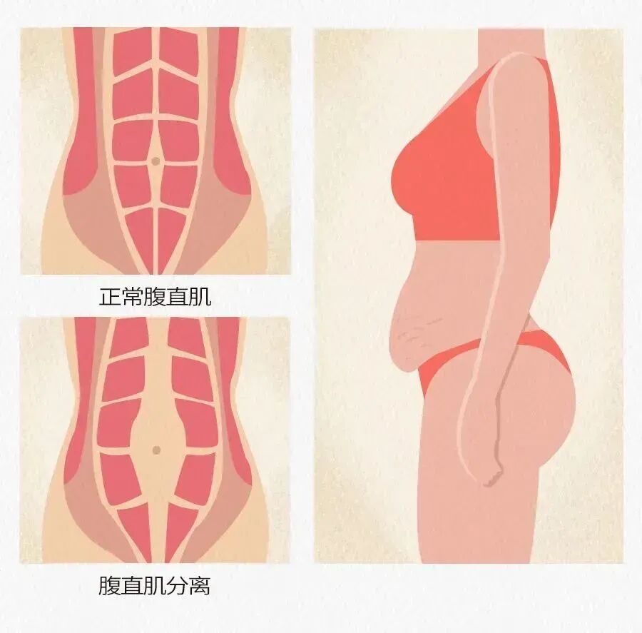 生娃後胯骨寬肚子胖？比減肥更有效的產後修復方法來了，產後多年都有效！
